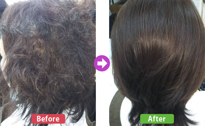 ハリスノフ施術例2